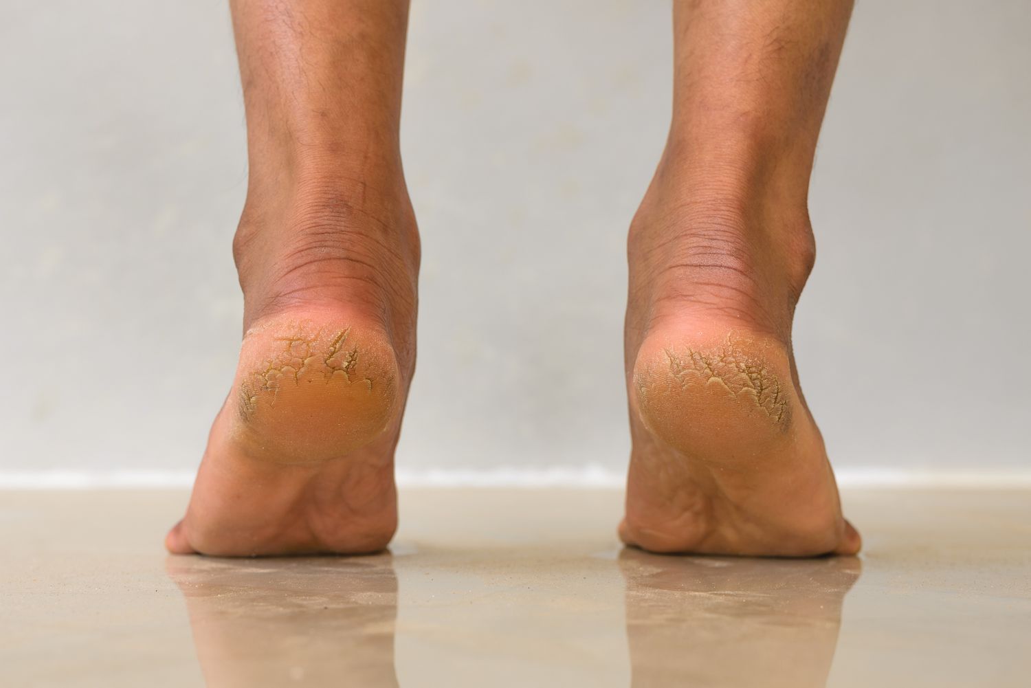 Cracked Heels: కాళ్ల పగుళ్లతో ఇబ్బంది పడుతున్నారా.. అయితే ఇలా చేయాల్సిందే?