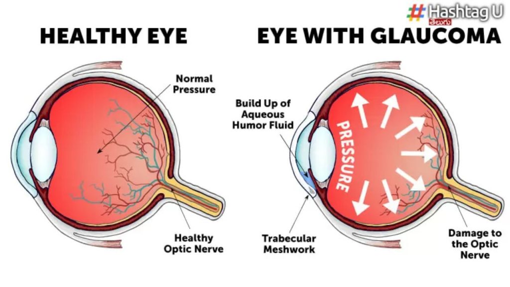 Glaucoma