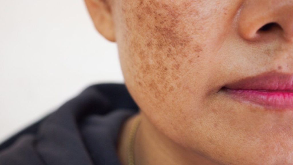 remedies for pigmentation