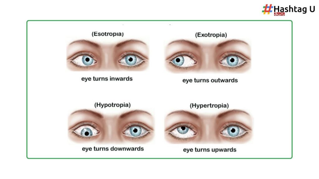 Congenital Squint
