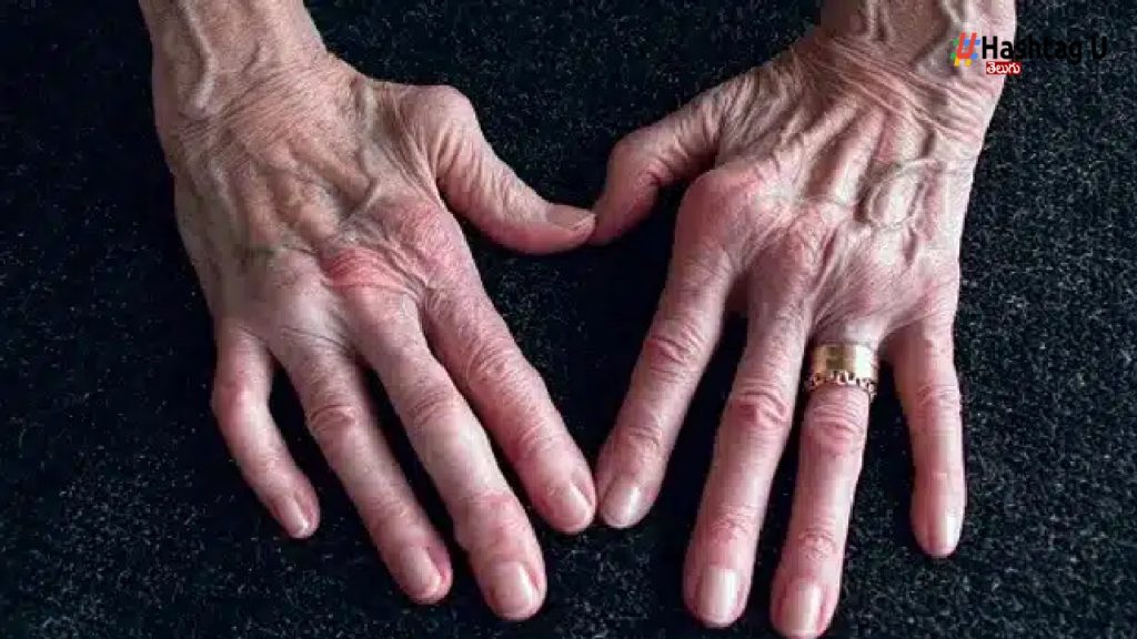 Rheumatoid Arthritis