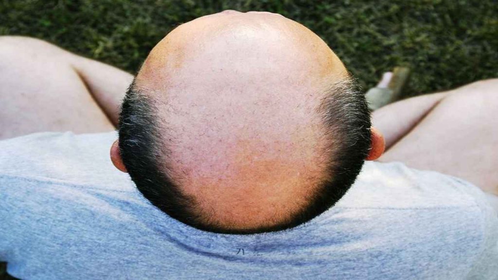 Hair Loss