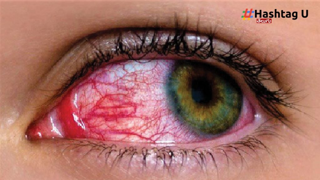 Eye Problem