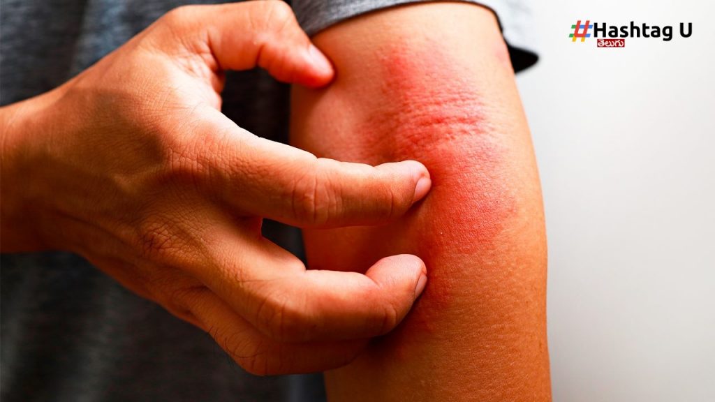 Itching