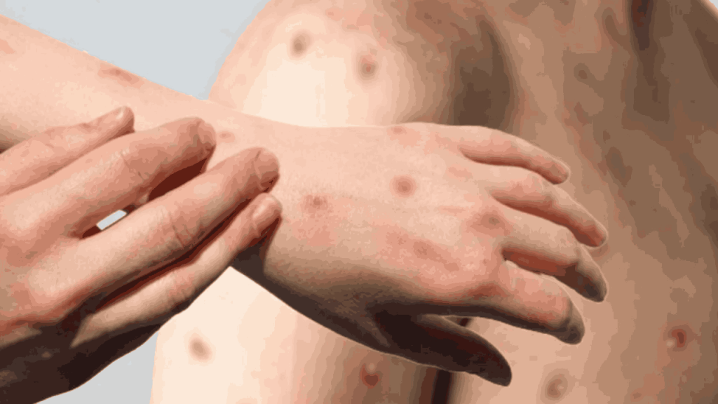 Mpox