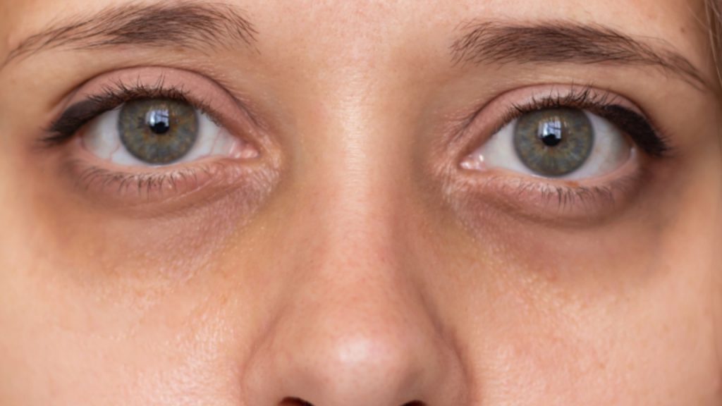 Dark Circles