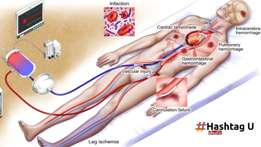 Ecpr Treatment