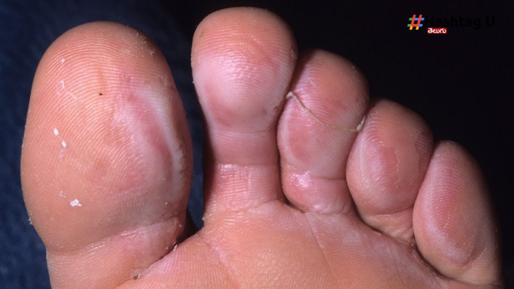 Fungal Infection