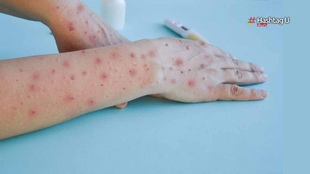 Monkey Pox Wards In Fever H