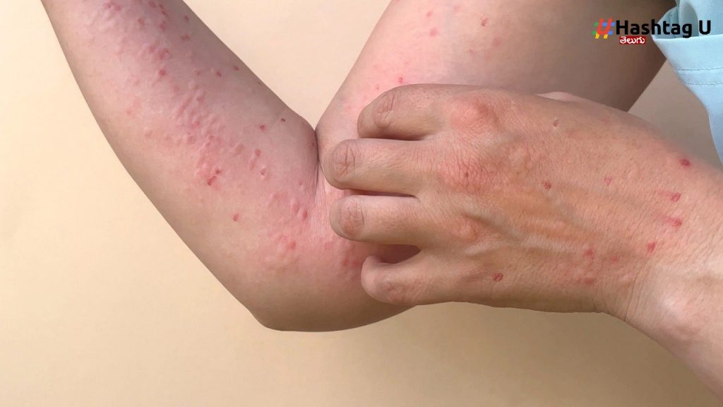 Monkeypox (1)