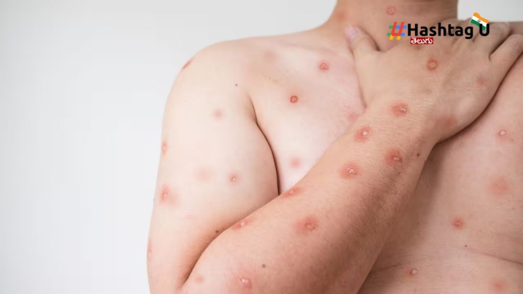 Monkeypox