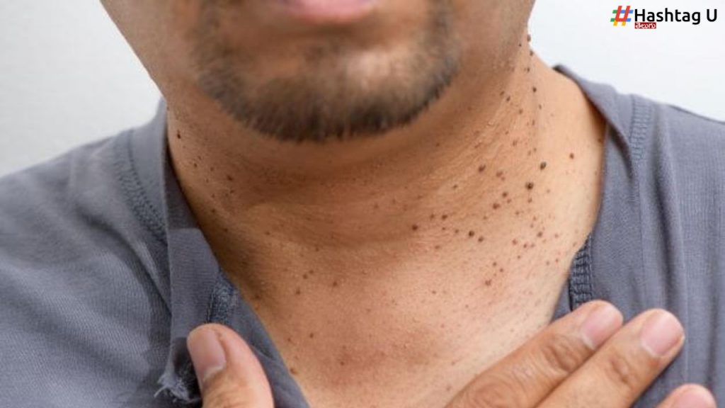 Skin Tags Vs Cancer