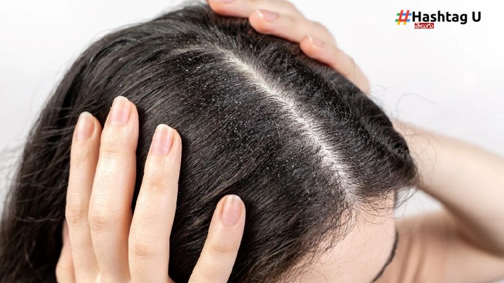 Dandruff