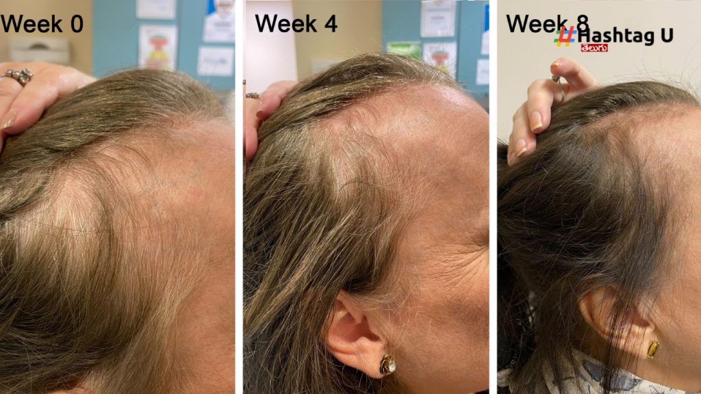 Prp Treatment