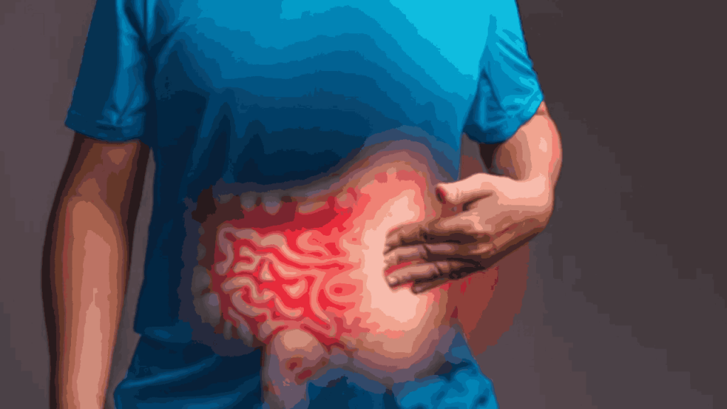 Irritable Bowel Syndrome