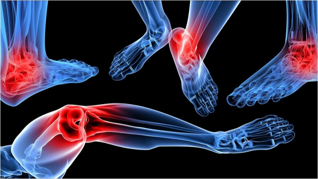 Arthritis