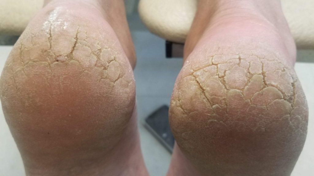 Cracked Heels