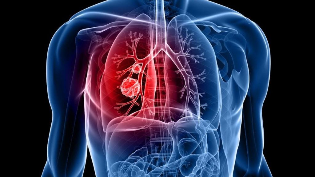 Lung Cancer