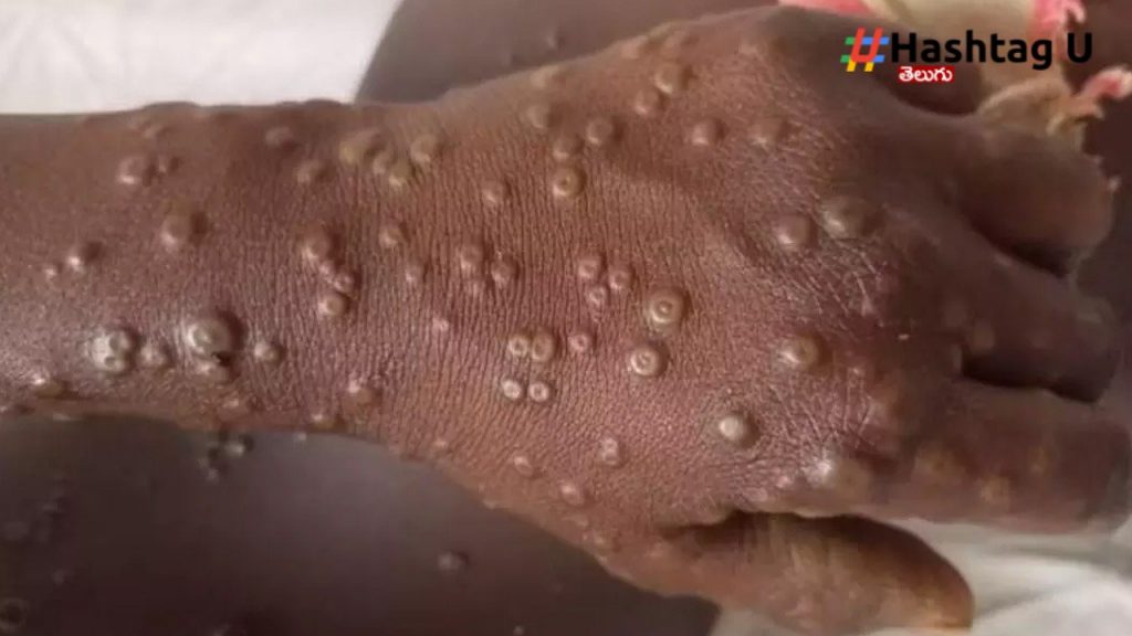 Monkeypox (3)