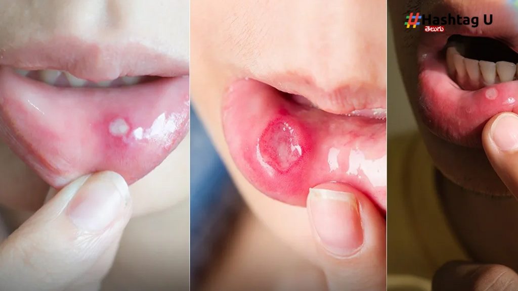 Mouth Ulcers