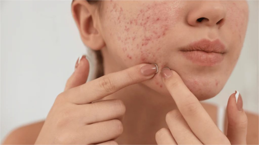 Pimples