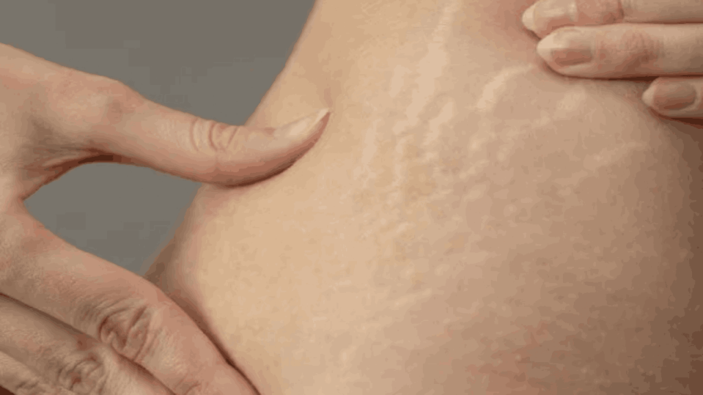 Stretch Marks