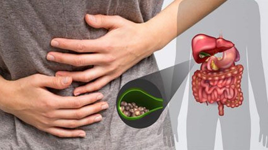 Gall Bladder Stones
