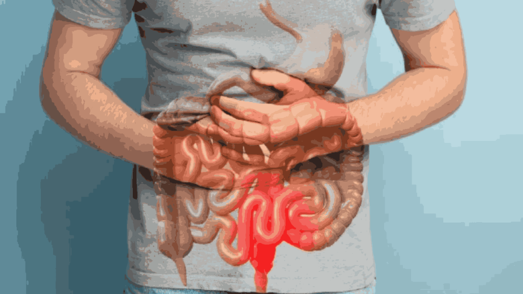 Colon Cancer