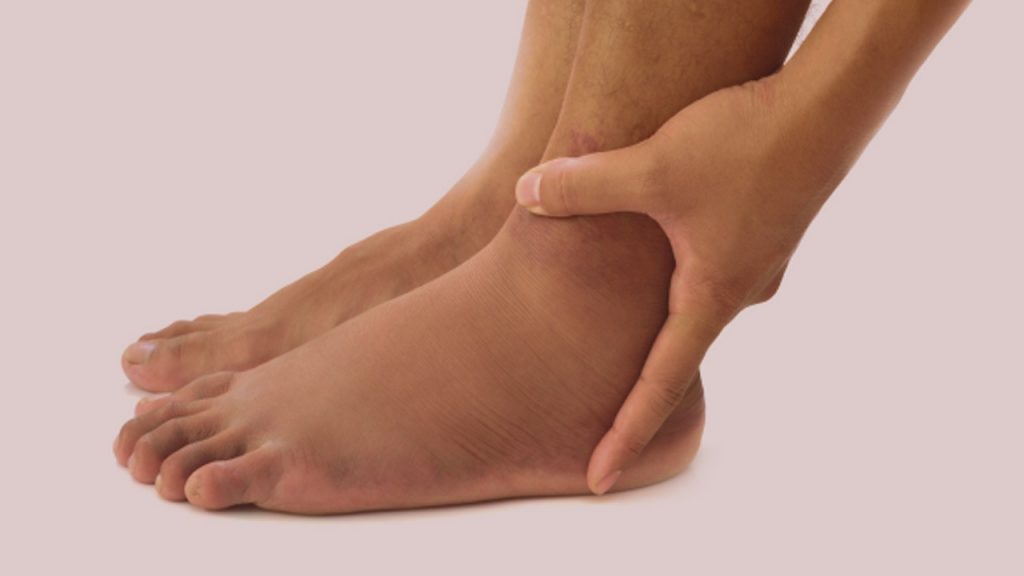 Swelling Feet