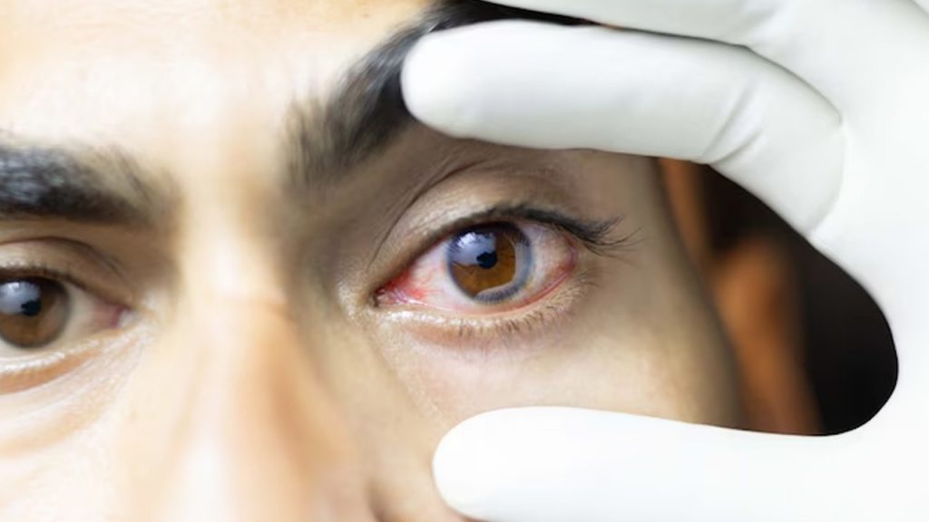 Trachoma