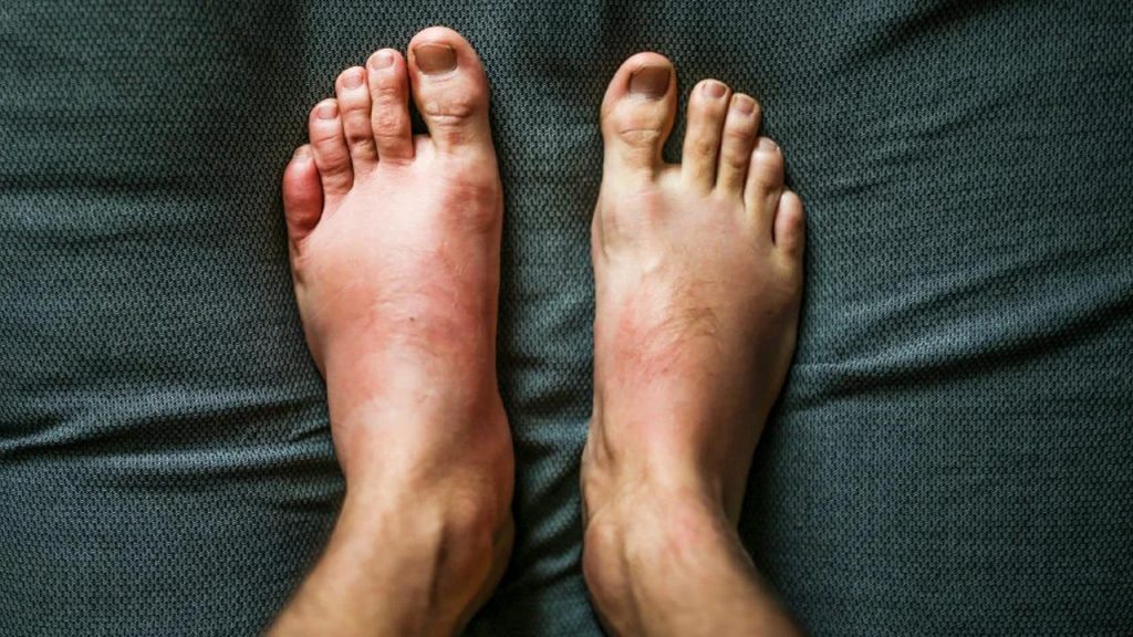 Sudden Swelling In The Limbs