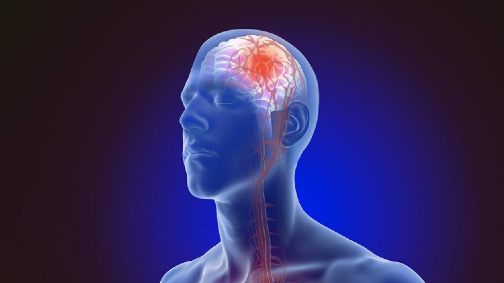 Brain Stroke