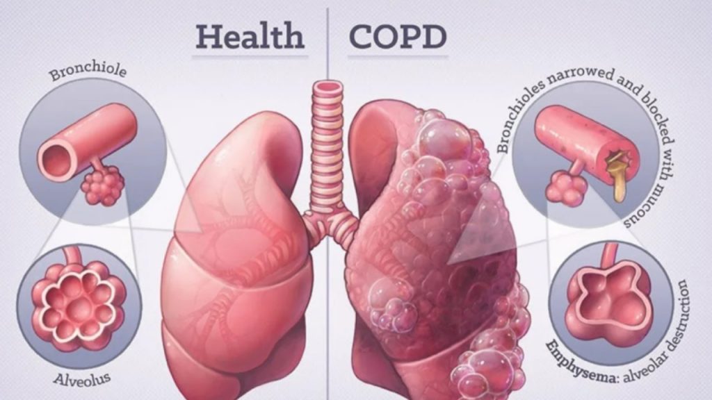 Copd