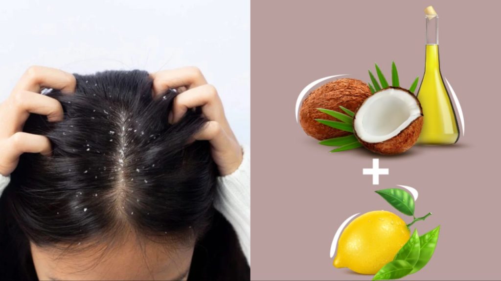 Dandruff