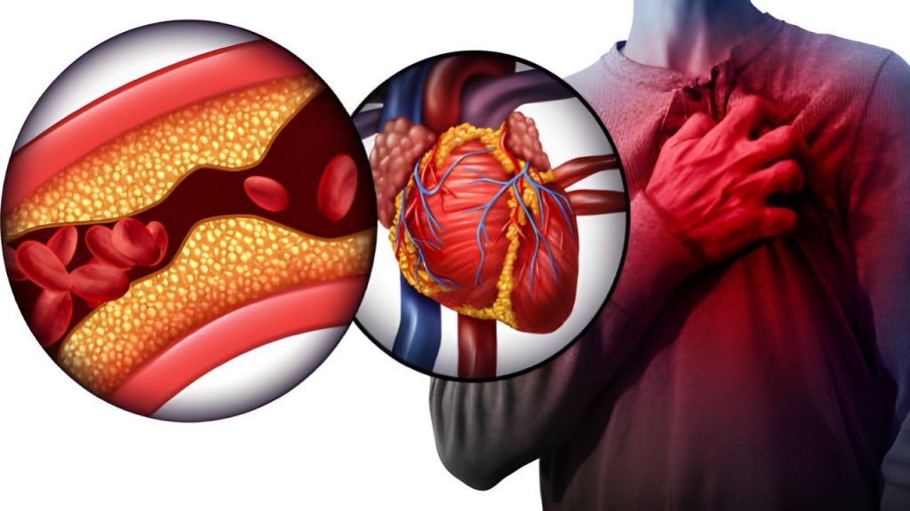 Heart Block