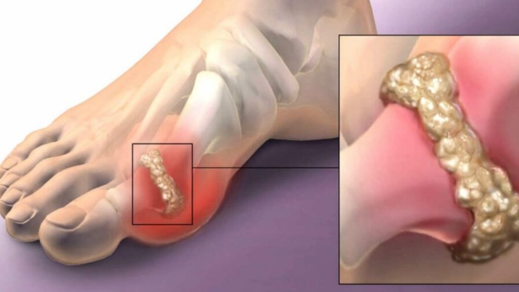 Uric Acid