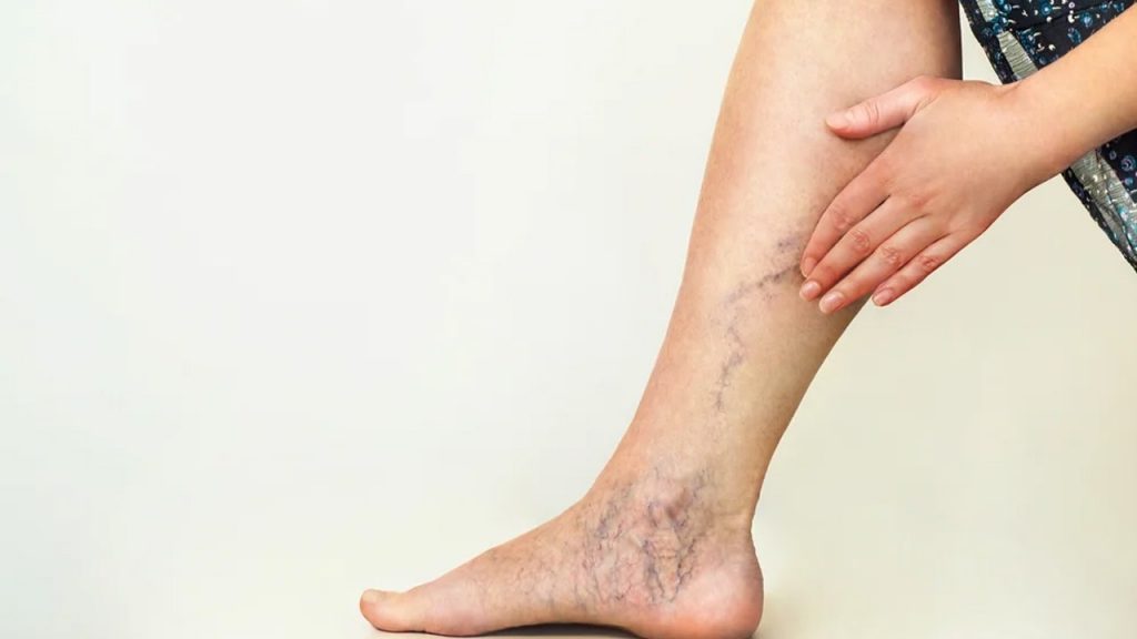 Varicose Veins