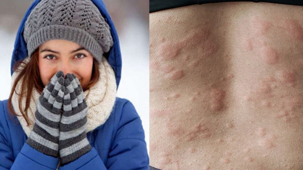 Woolen Clothes Allergy