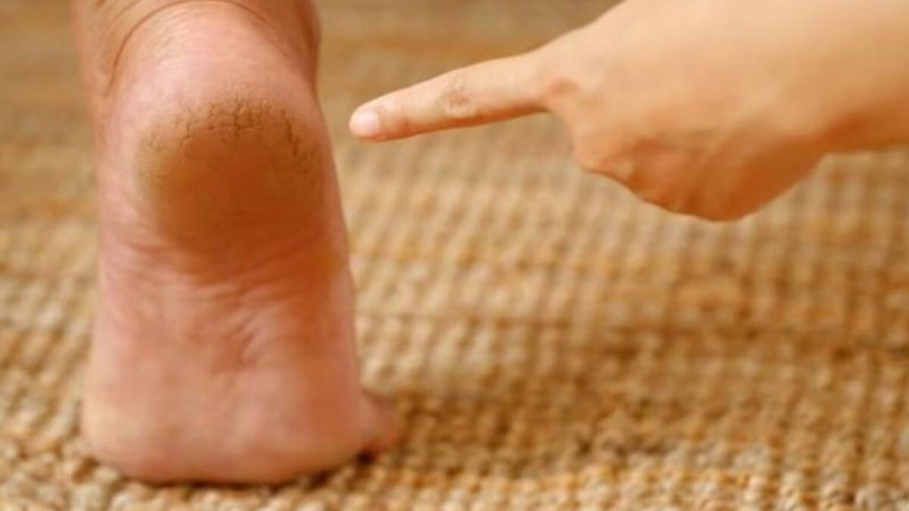 Cracked Heels