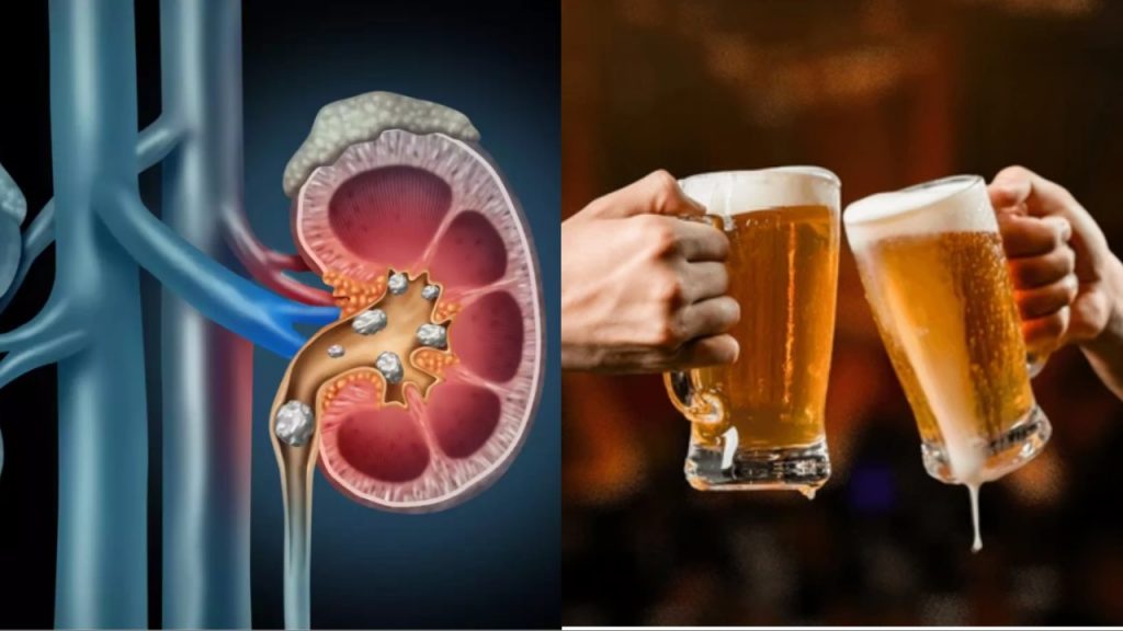 Beer For Kidney Stones