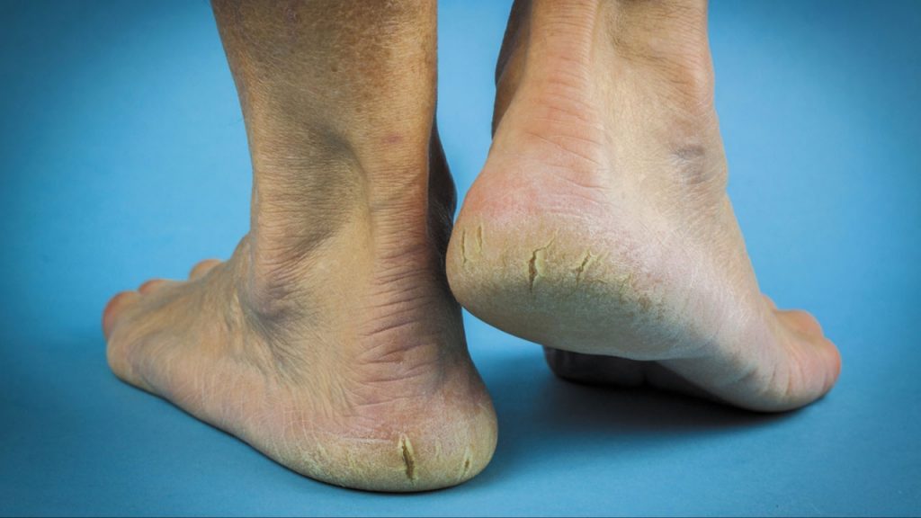 Cracked Heels