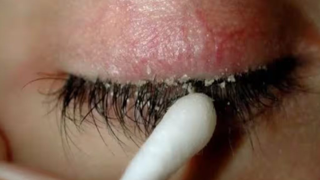 Eyelash Dandruff