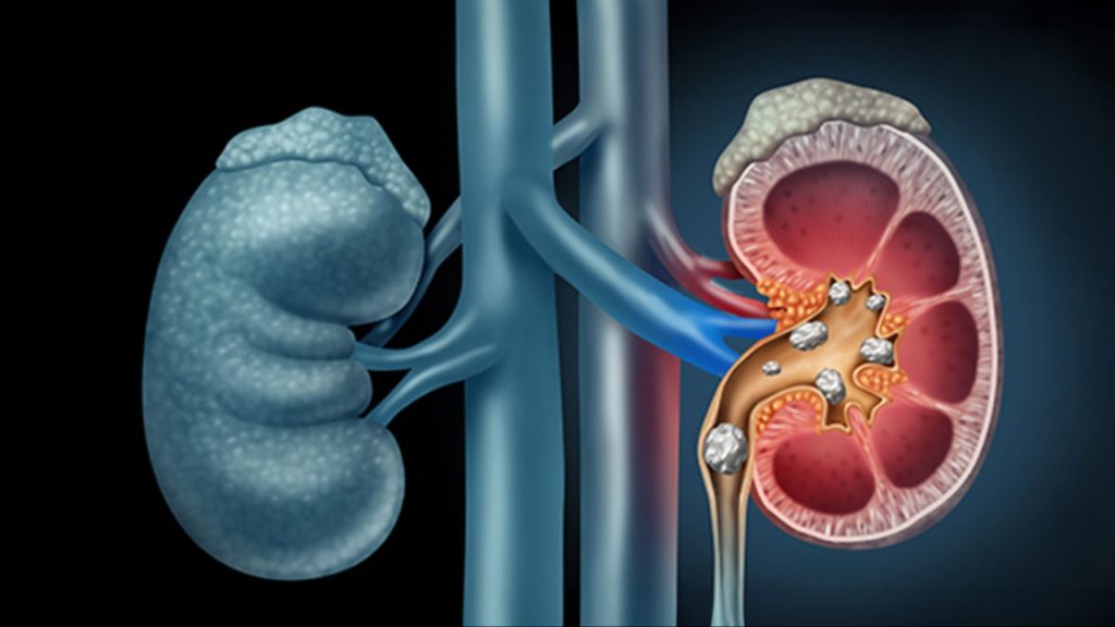 Kidney Stones