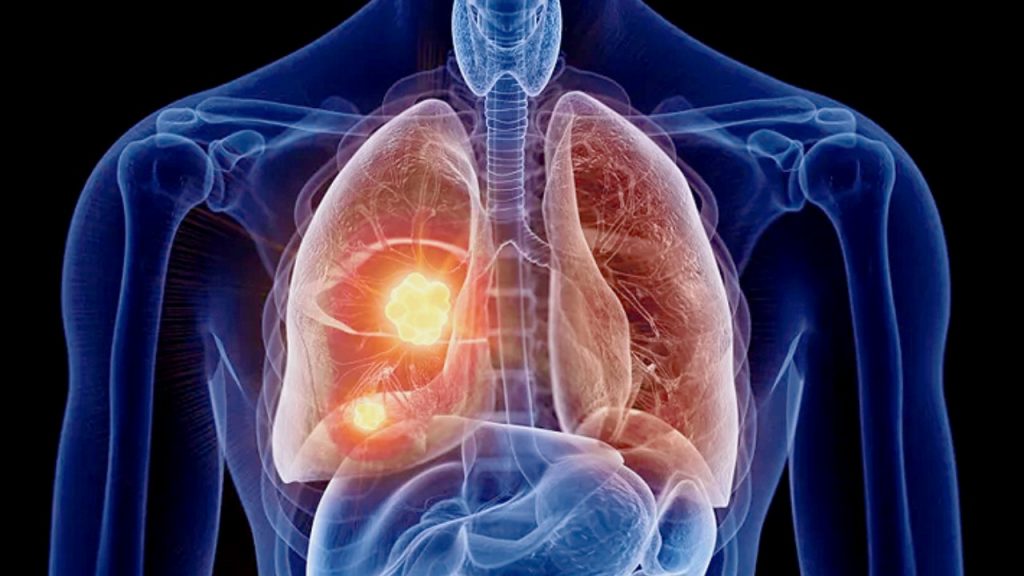 Lung Cancer Vs Lung Tumor