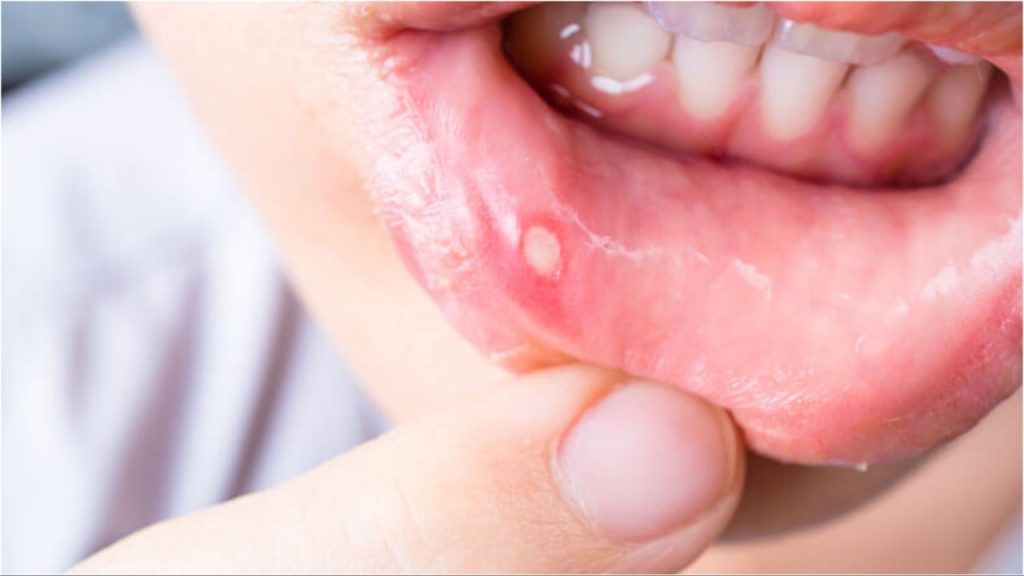 Mouth Ulcers