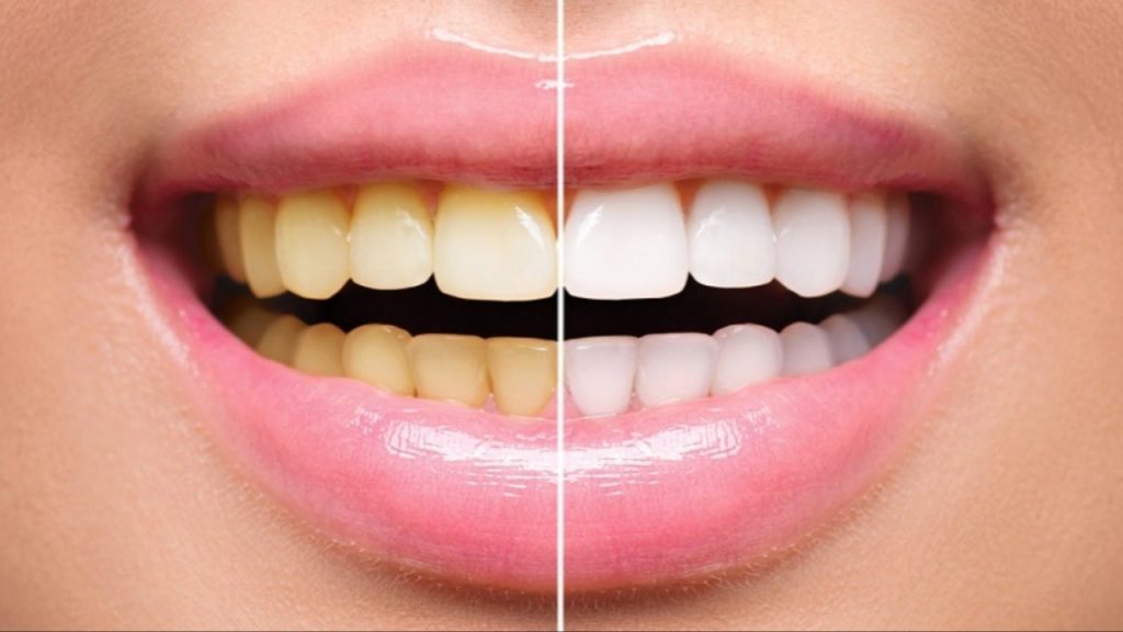 Yellow Teeth