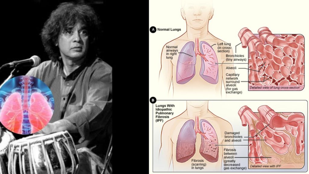 Zakir Hussain Idiopathic Pulmonary Fibrosis
