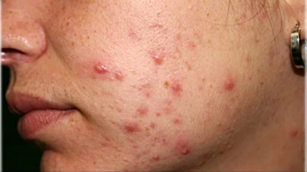 Pimples On Face