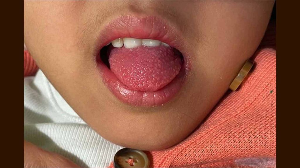 Scarlet Fever