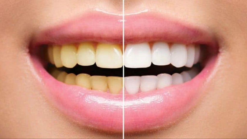 Yellow Teeth